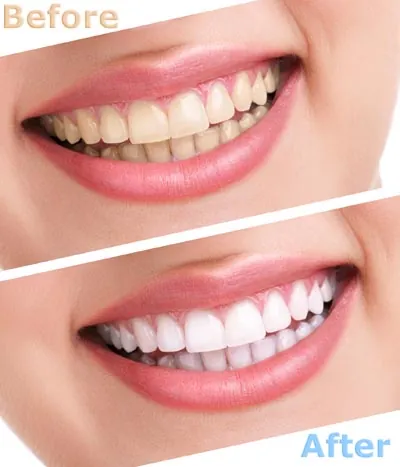 before and after showing the impact teeth whitening has on a smile